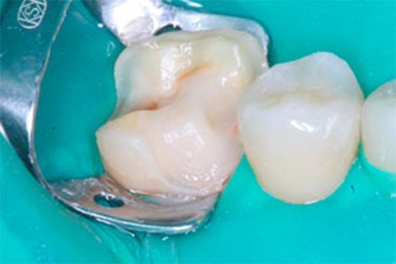 Ортодонтическое лечение зубов