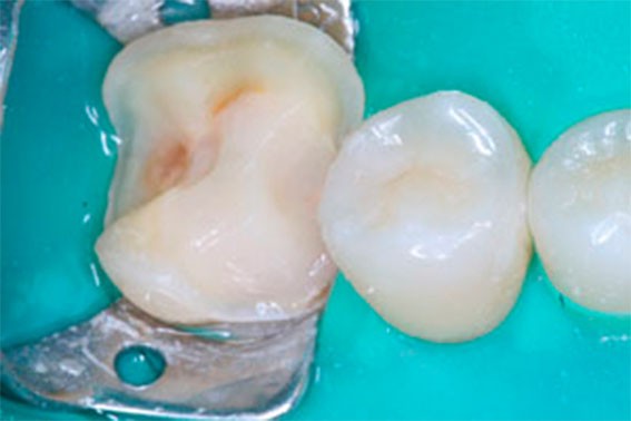 Ортодонтическое лечение зубов фото 2