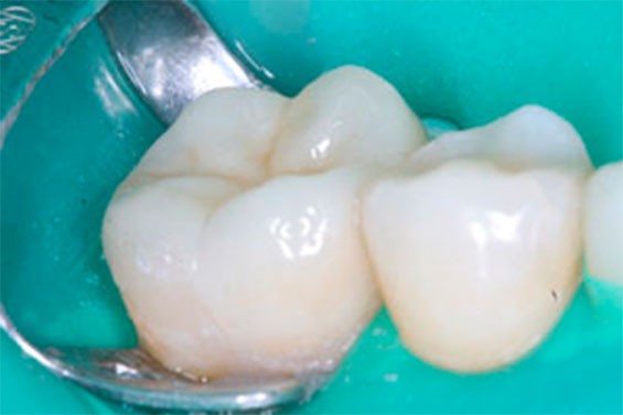 Ортодонтическое лечение зубов фото 3