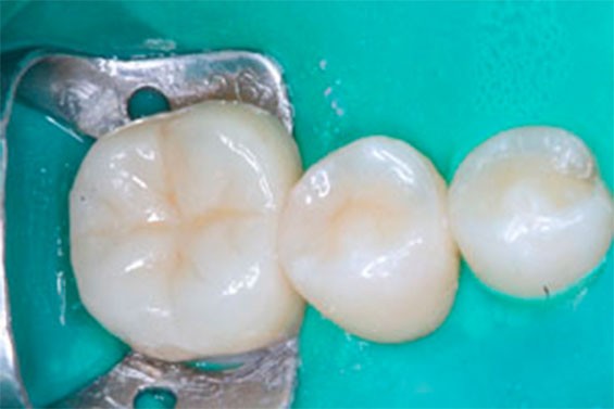 Ортодонтическое лечение зубов фото 4