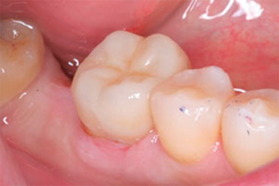 Ортодонтическое лечение зубов фото 5