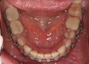 Уставнока временных коронок на зубах фото Уставнока временных коронок на зубах фото