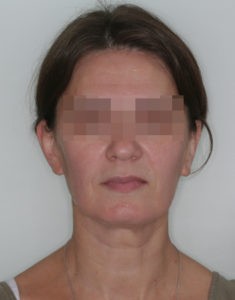 Результат лечения дисфункции височно-нижнечелюстного сустава фото Результат лечения дисфункции височно-нижнечелюстного сустава фото