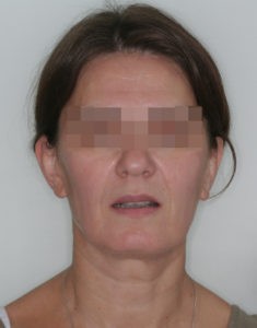 Результат лечения дисфункции височно-нижнечелюстного сустава фото 2 Результат лечения дисфункции височно-нижнечелюстного сустава фото 2