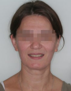 Результат лечения дисфункции височно-нижнечелюстного сустава фото 3 Результат лечения дисфункции височно-нижнечелюстного сустава фото 3