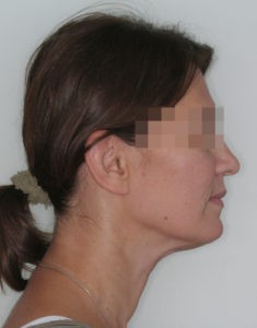 Результат лечения дисфункции височно-нижнечелюстного сустава фото 4 Результат лечения дисфункции височно-нижнечелюстного сустава фото 4