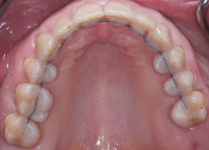 Результат лечения дисфункции височно-нижнечелюстного сустава фото 10 Результат лечения дисфункции височно-нижнечелюстного сустава фото 10