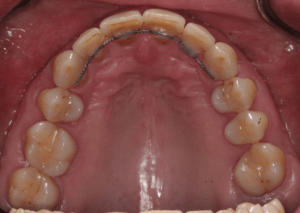 Результат лечения дисфункции височно-нижнечелюстного сустава фото 13 Результат лечения дисфункции височно-нижнечелюстного сустава фото 13