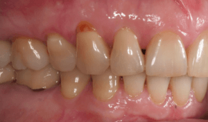 Результат лечения дисфункции височно-нижнечелюстного сустава фото 14 Результат лечения дисфункции височно-нижнечелюстного сустава фото 14