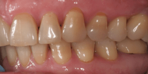 Результат лечения дисфункции височно-нижнечелюстного сустава фото 16 Результат лечения дисфункции височно-нижнечелюстного сустава фото 5