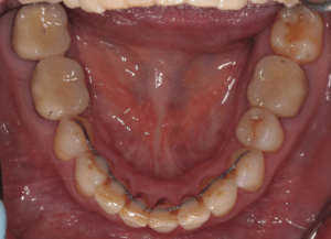 Результат лечения дисфункции височно-нижнечелюстного сустава фото 5 Результат лечения дисфункции височно-нижнечелюстного сустава фото 16