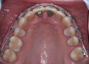 Установка накусочных брекетов фото Установка накусочных брекетов фото