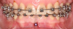 Установка накусочных брекетов фото 2 Установка накусочных брекетов фото 2