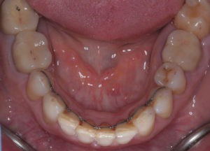 Снятие брекетов фото Снятие брекетов фото